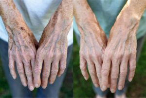 Hands Started Looking Veiny and Spotted Overnight and the Rheumatologist Discovered It Was Early… The $87,000 Treatment I Was Told I Needed But Never Had (The Simple Fix That Saved My Retirement Savings)