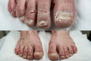 ATTENTION: IF YOU HAVE THIS ON YOUR FEET IT MEANS YOU ARE INFECTED WITH…