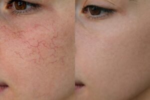 Tiny Red Veins Popped Up All Over My Cheeks After Using a New Cream That Actually… The Simple Fix That Saved My Retirement Savings