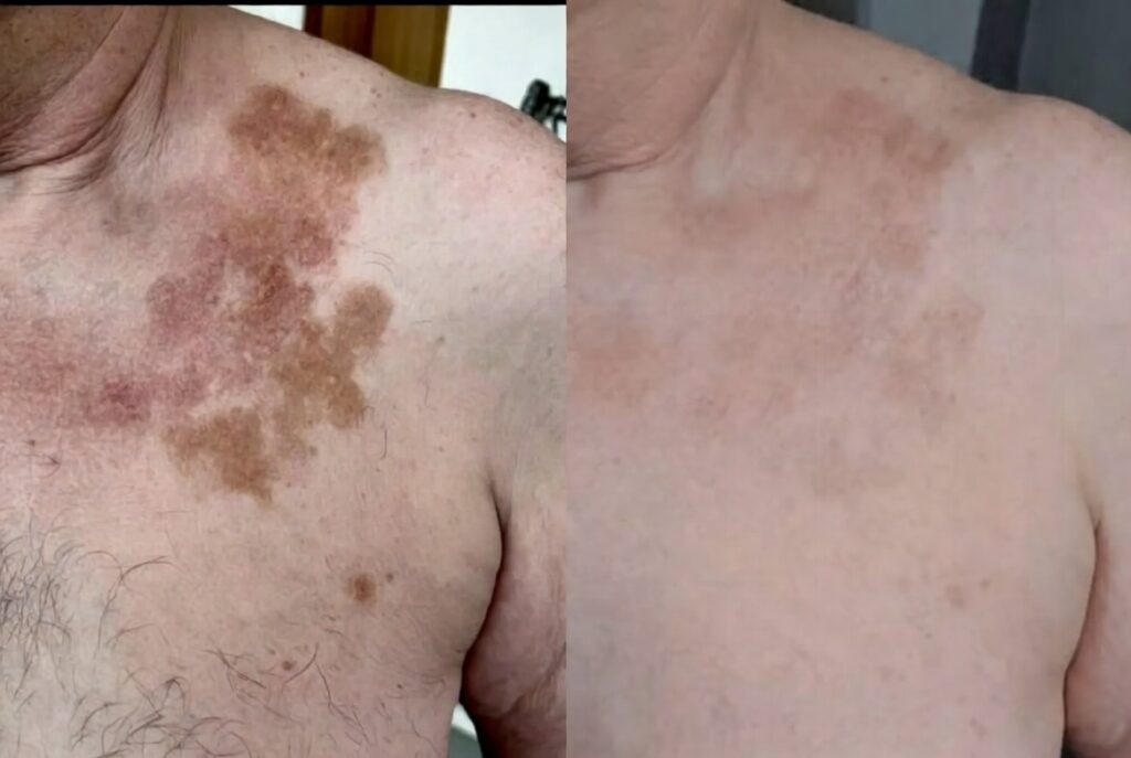 Skin on My Chest Got Brown Patches That Spread Fast and One Biopsy Came Back as… The $12,400 Treatment I Was Told I Needed But Never Had (The Simple Fix That Saved My Retirement Savings)