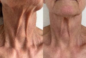 My Neck Developed Vertical Bands That Wouldn’t Go Away and the Scan Showed Pressure on My… The $94,000 Surgery I Was Told I Needed But Never Had (The Simple Fix That Saved My Retirement Savings)