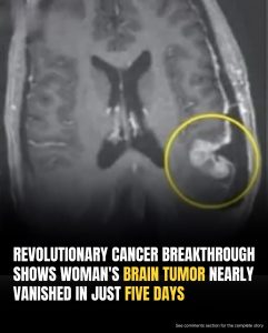 Inoperable Brain Tumor Shrinks Dramatically in Just Days: Breakthrough CAR-T Therapy Offers New Hope for Glioblastoma Patients and Families