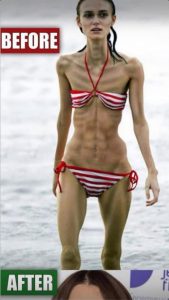 Severe Acne Destroyed My Daughter’s Confidence — How We Finally Found Hope