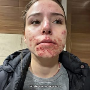 Still Getting Pimples on Your Chin as an Adult? Real Reasons Revealed