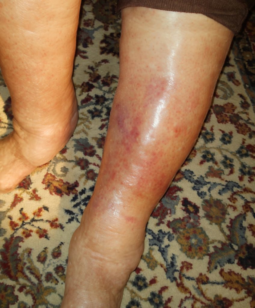 Why a Simple Skin Blemish Could Be More Dangerous Than You Think