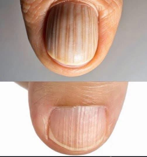 Your Nails Are Sending A Secret Message: Why You Should Never Ignore These Strange Lines On Your Hands