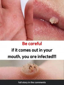 Doctors Say These Wart Removal Tricks Actually Work — But There’s a Catch