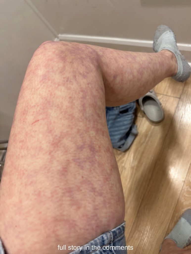 Why Heating Pads and Electric Blankets Leave Marks on Your Skin