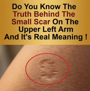 The Smallpox Vaccine Scar – What That Small Mark Really Means And Why It Still Matters Today For Your Retirement Savings And Grandchildren’s Future