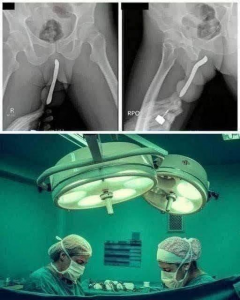 Girl Had To Be Hospitalized For Wanting To Use A Pen In A Dangerous Way Doctors Warn Parents About This Alarming Trend