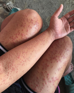 The Hidden Killer in Your Bed: Why Those Itchy Red Patches When You Wake Up Could Be a Life-Threatening Medical Emergency