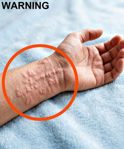 These Are the Consequences of Sleeping With an Allergic Reaction – Why a Simple Rash Can Turn Into a Life-Threatening Emergency
