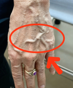 Why Are Your Veins Suddenly Bulging and Visible? The Real Reasons Hiding in Plain Sight (And When You Should Actually Worry)