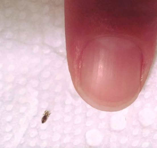 Head Lice: Effective Ways to Remove Them and Prevent Reinfestation