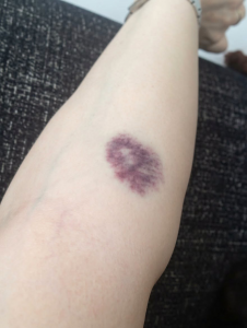 THE SILENT KILLER ON YOUR SKIN: WHY THOSE MYSTERIOUS BRUISES ARE SCREAMING FOR YOUR ATTENTION