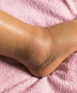 The Silent Danger Beneath Your Skin: Why Your Swollen Legs Are Screaming for Help