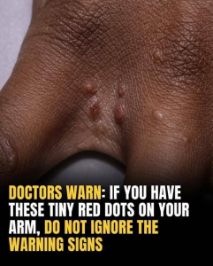 Is That Itchy Rash on Your Hands a Warning Sign of Dyshidrotic Eczema?