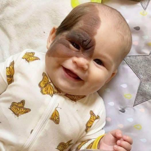 The $80,000 Battle to Erase a Birthmark: Why One Mother Risked Everything for Her Daughter’s Future